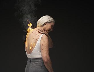 A female model with simulated prurigo nodularis reaches over her shoulder to scratch raised firm nodules on her back due to severe itch she suffers