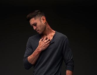 A man with simulated atopic dermatitis scratches at diffuse lesions on his neck while gazing downward