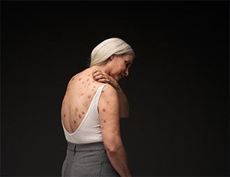 A female model with simulated prurigo nodularis reaches over her shoulder to scratch raised firm nodules on her back due to severe itch she suffers