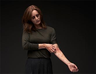 A woman with simulated atopic dermatitis gazes downward and scratches a diffuse lesion on her left arm