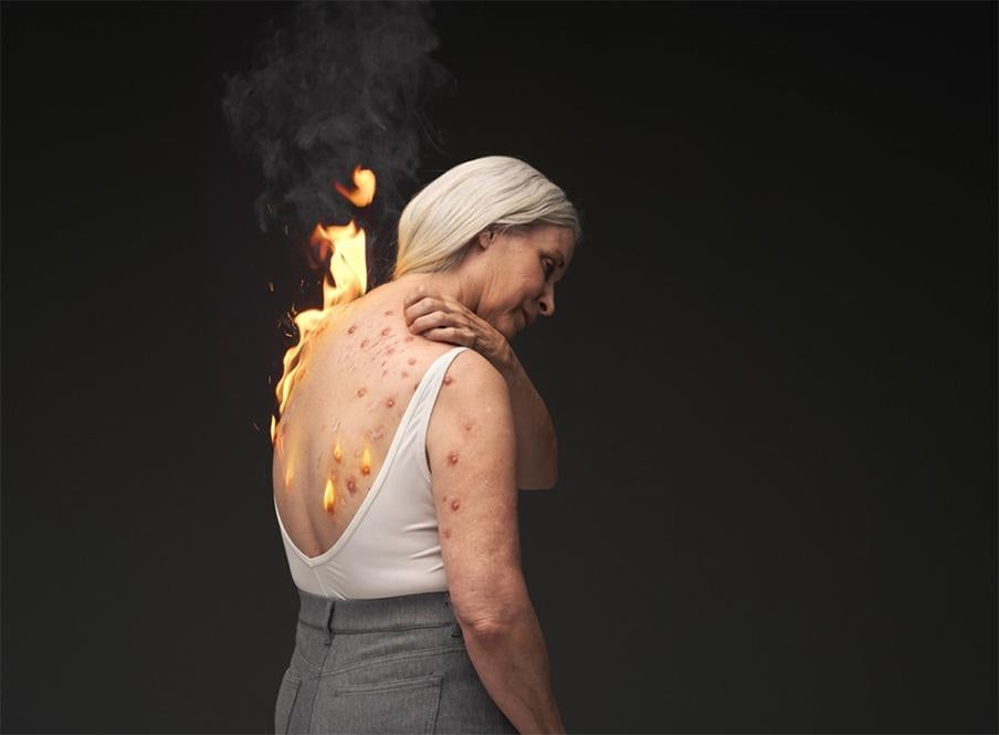 A woman with simulated prurigo nodularis reaches over her shoulder to scratch raised firm nodules on her back due to severe itch she suffers
