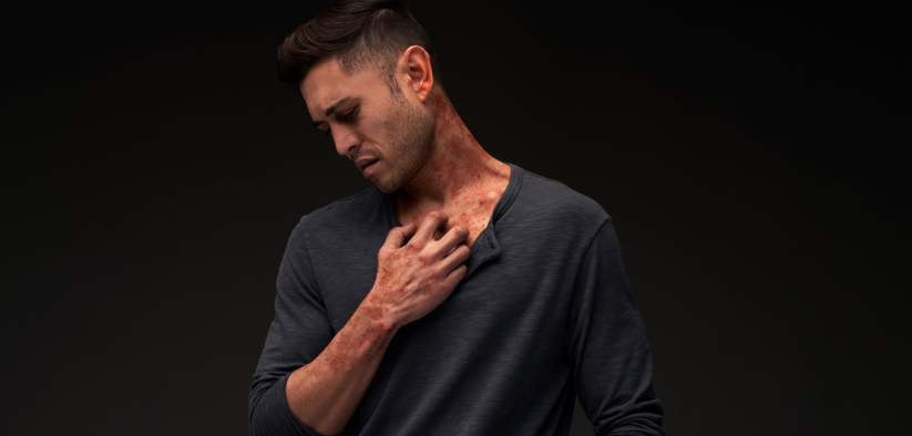 A man with simulated atopic dermatitis scratches at diffuse lesions on his neck while gazing downward