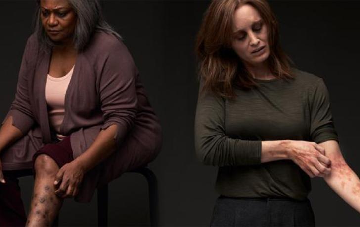 A woman with simulated prurigo nodularis reaches down to scratch raised firm nodules on her lower leg due to severe itch she suffers; A woman with simulated atopic dermatitis gazes downward and scratches a diffuse lesion on her left arm due to severe itch she suffers