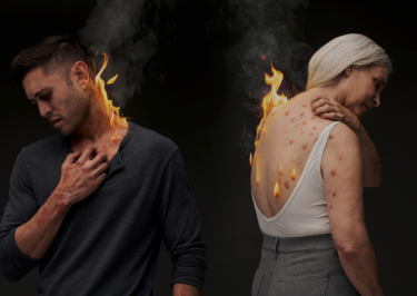 A male model with simulated atopic dermatitis scratches a diffuse, red lesion at his neck; a female model with simulated prurigo nodularis reaches over her shoulder to scratch raised firm nodules on her back. On both, flickering flames arising from affected skin symbolically represents the burden of their disease.