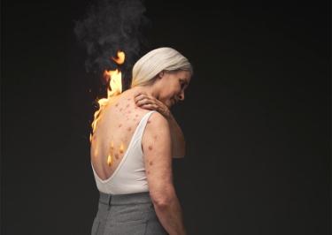 A woman with simulated prurigo nodularis reaches over her shoulder to scratch raised firm nodules on her back; flames in motion symbolically represent the burden of her disease symptoms